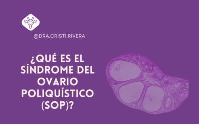 ¿Qué es el Síndrome del Ovario Poliquístico (SOP)?
